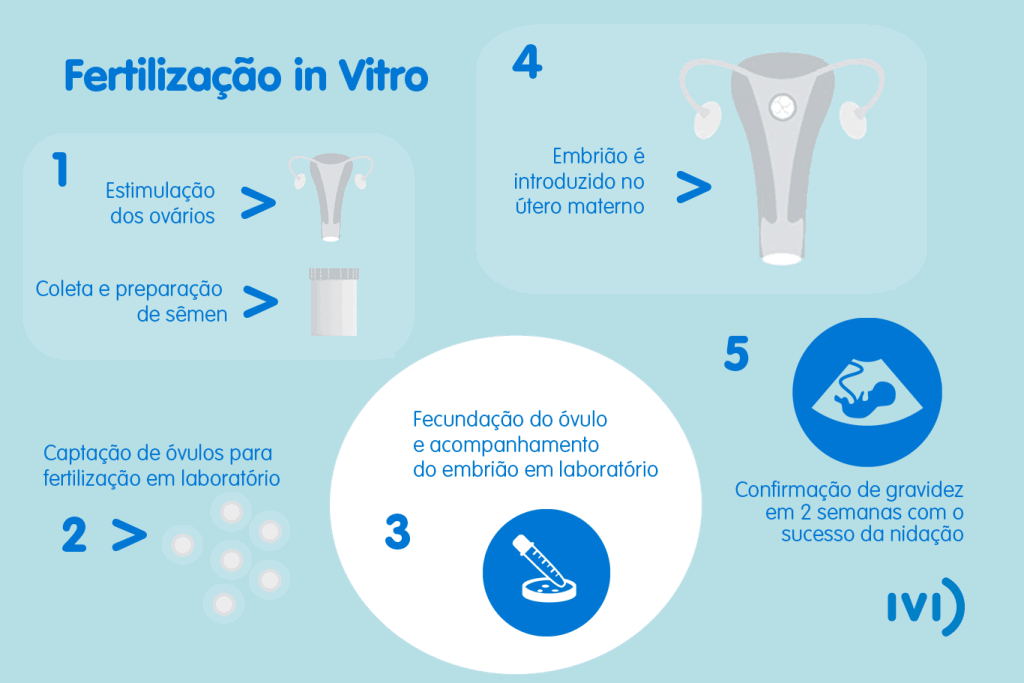 Infográfico do tratamento de Fertilização in Vitro