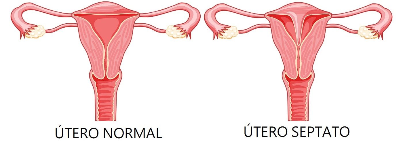 Malformações uterinas: como ocorrem?