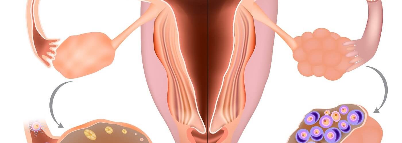 Hiperestimulação ovariana