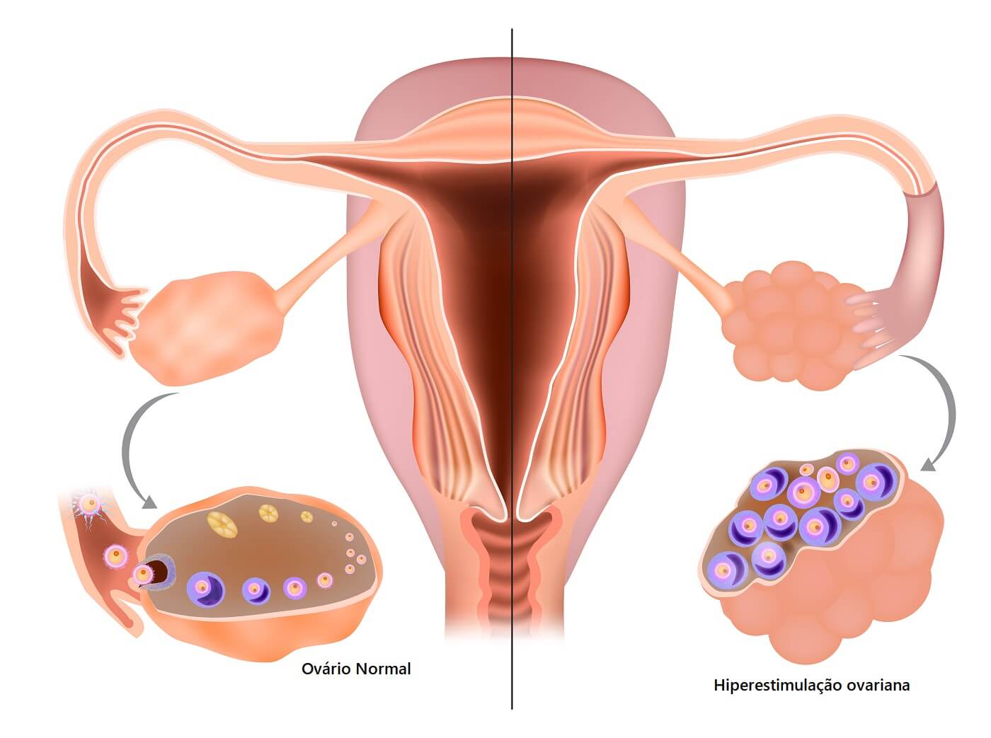 Por Que Ocorre A S Ndrome De Hiperestimula O Ovariana Ivi Br