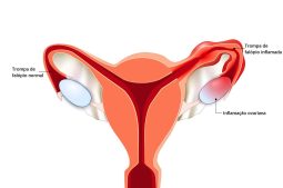 Coágulo menstrual ou aborto?