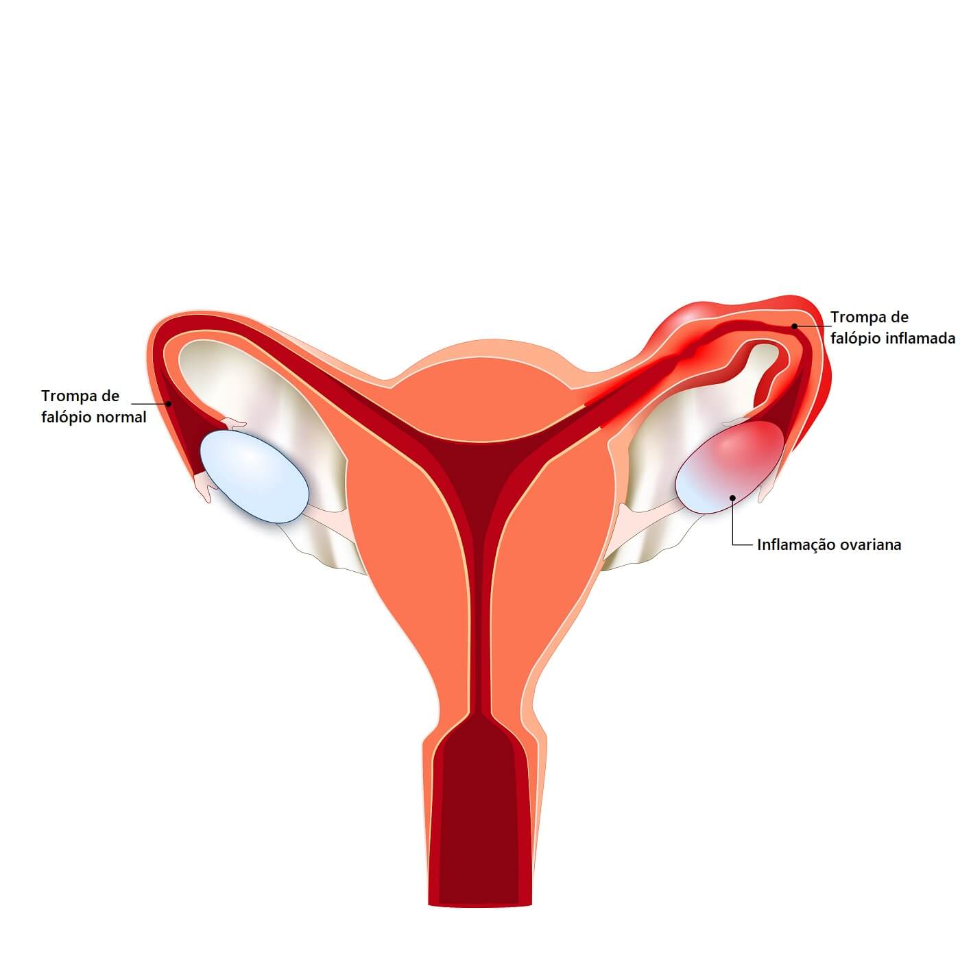 Ooforite ou ovarite: sintomas, causas e tratamento