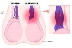 Varicocele: doença deixa os homens em alerta