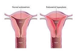 Hiperplasia Endometrial: diagnóstico, impactos e caminhos para a cura