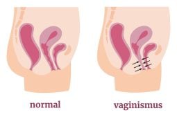 Vaginismo: o que é, sintomas, causas e tratamentos