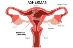 Síndrome de Asherman