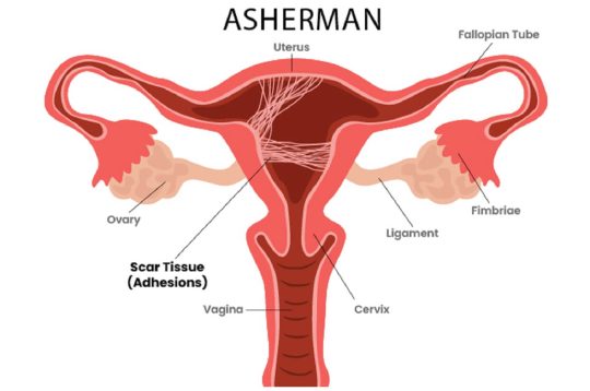 Síndrome de Asherman