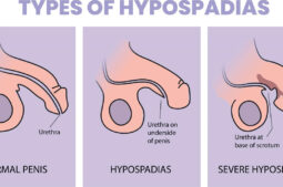 Hipospádia: como afeta a fertilidade?